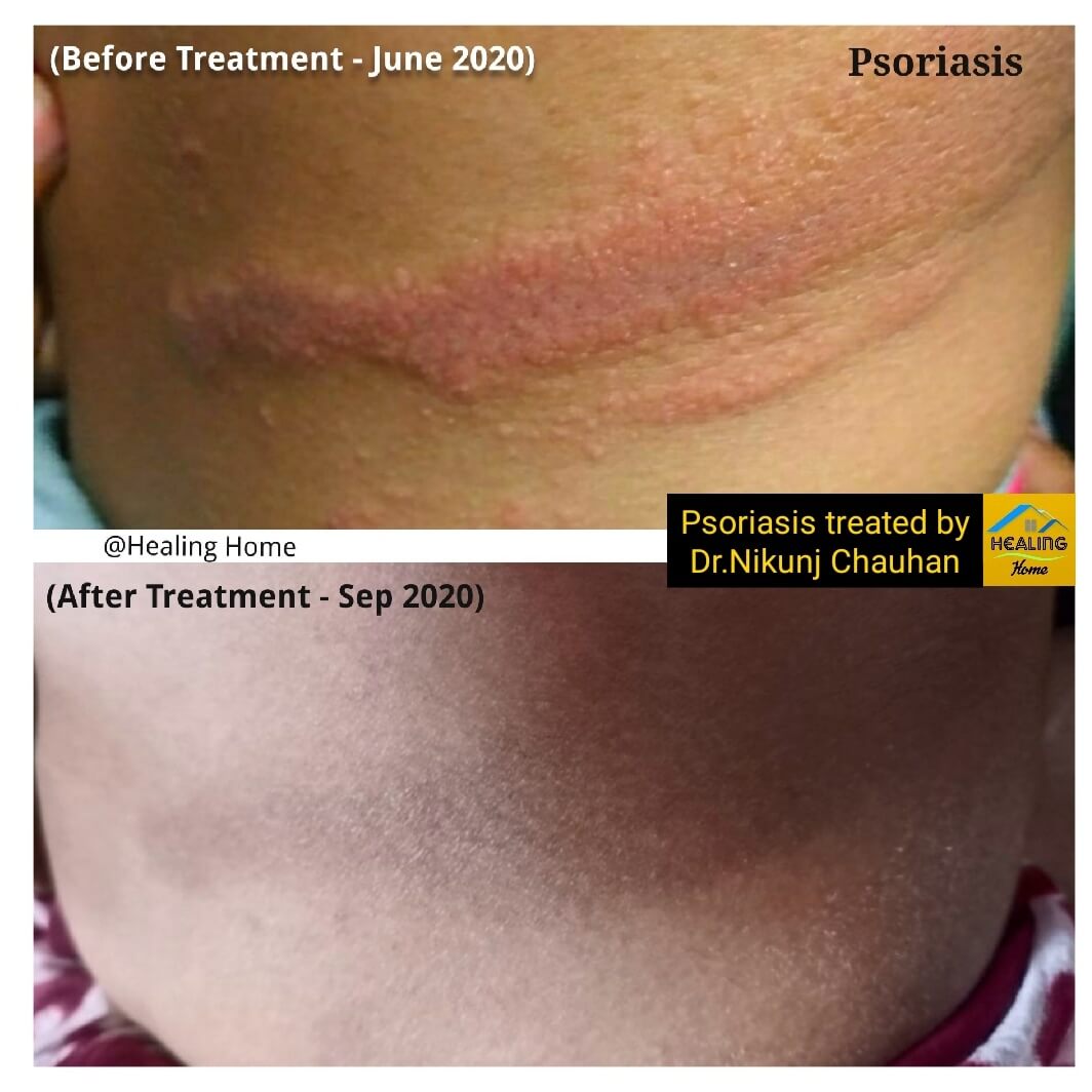 Tinea Pedis problem