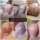Tinea Pedis 